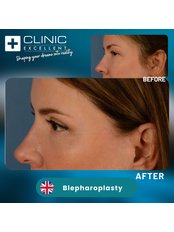Blepharoplasty - Clinic Excellent