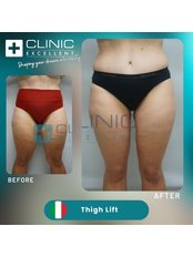 Thigh Lift - Clinic Excellent
