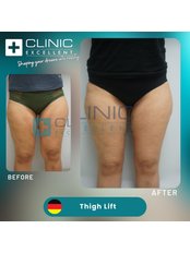 Thigh Lift - Clinic Excellent