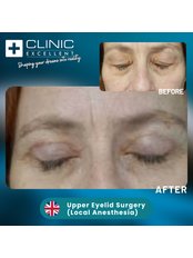 Eyelid Surgery - Clinic Excellent