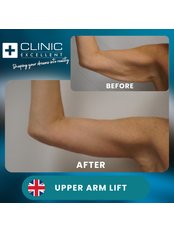 Arm Lift - Clinic Excellent