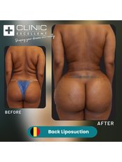 Back Liposuction - Clinic Excellent