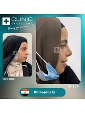Closed Rhinoplasty - Clinic Excellent