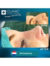 Closed Rhinoplasty - Clinic Excellent