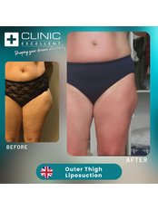 Thigh Liposuction - Clinic Excellent