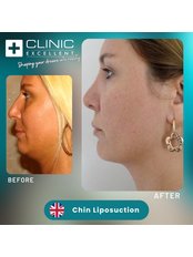 Neck Liposuction - Clinic Excellent
