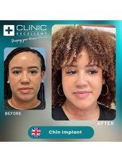 Chin Implant - Clinic Excellent