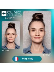 Otoplasty - Clinic Excellent