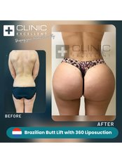 BBL - Brazilian Butt Lift - Clinic Excellent