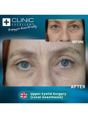 Eyelid Surgery - Clinic Excellent