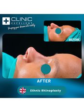 Rhinoplasty - Clinic Excellent