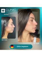 Chin Implant - Clinic Excellent