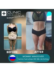 Mommy Makeover - Clinic Excellent