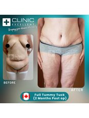 Full Abdominoplasty - Clinic Excellent