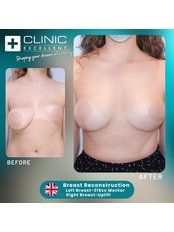 Breast Reconstruction - Clinic Excellent
