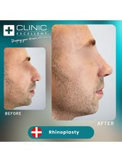 Rhinoplasty - Clinic Excellent