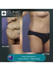 Post-Bariatric Plastic Surgery - Clinic Excellent