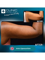 Arm Liposuction - Clinic Excellent