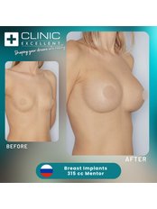 Breast Implants - Clinic Excellent
