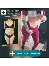 Tummy Tuck - Clinic Excellent