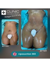 Liposuction - Clinic Excellent