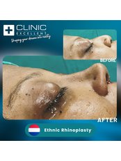 Open Rhinoplasty - Clinic Excellent
