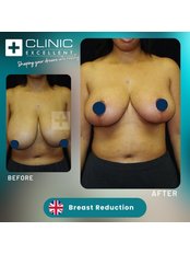 Breast Reduction - Clinic Excellent