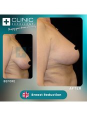 Breast Reduction - Clinic Excellent