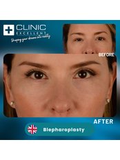 Blepharoplasty - Clinic Excellent