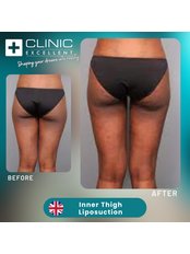 Thigh Liposuction - Clinic Excellent