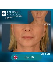 Lip Lift - Clinic Excellent