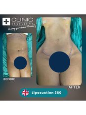 Liposuction - Clinic Excellent