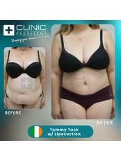 Tummy Tuck - Clinic Excellent
