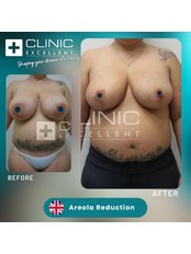 Areola Reduction - Clinic Excellent