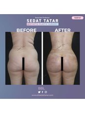 Tummy Tuck - Dr Sedat TATAR Clinic