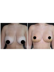 Breast Lift - Dr Sedat TATAR Clinic
