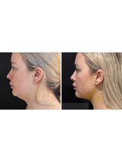 Double Chin Surgery - Dr Sedat TATAR Clinic