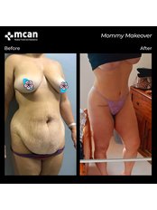 Mommy Makeover - Breast Surgeries + Liposuction + TummyTuck Combined - MCAN Health Plastic Surgery