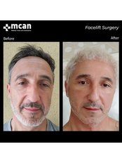 Facelift - MCAN Health Plastic Surgery