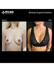 Breast Implants - MCAN Health Plastic Surgery