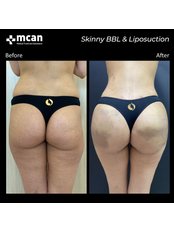 BBL - Brazilian Butt Lift - MCAN Health Plastic Surgery