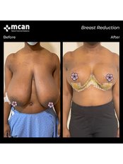 Breast Reduction - MCAN Health Plastic Surgery
