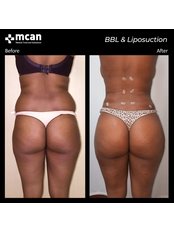 BBL - Brazilian Butt Lift - MCAN Health Plastic Surgery