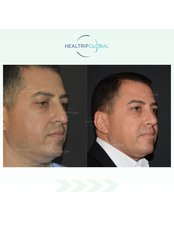 Eyelid Surgery - HealTrip Global