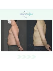 Liposuction - HealTrip Global