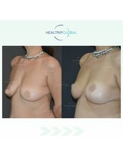 Breast Lift - HealTrip Global