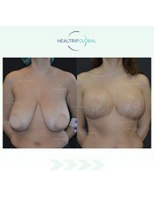 Breast Reduction - HealTrip Global