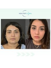 Buccal Fat Removal - HealTrip Global