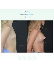 Breast Implants - HealTrip Global