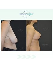 Breast Reduction - HealTrip Global
